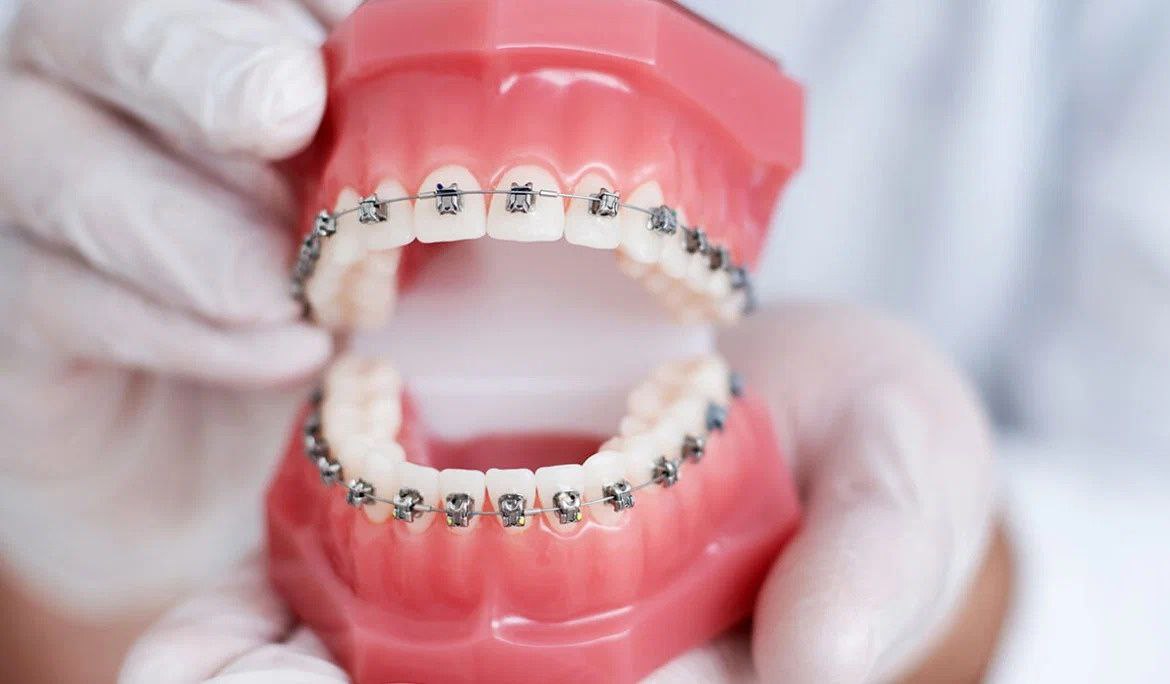 Брекеты – способ выравнивания зубов при любой клинической картине